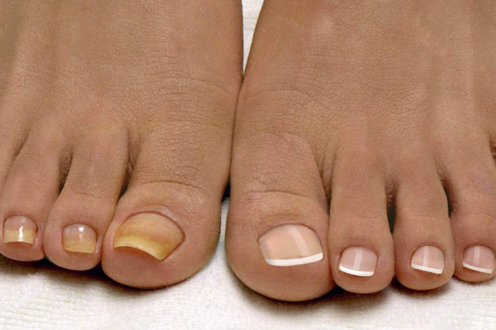 Estudo de eficácia ClearNail™